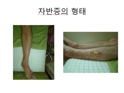 자반증의_형태1