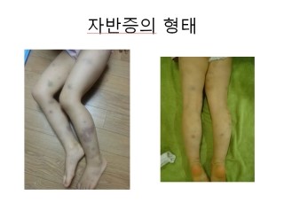 자반증의_형태2