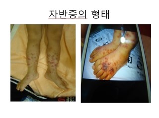 자반증의_형태3