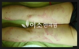 ㅇㅎㅅ_20년된_만성_두드러기_치료_전