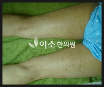 ㅇㅎㅅ_20년된_만성_두드러기_치료_후