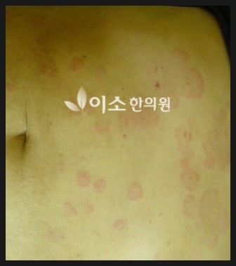 ㅇㅎㅅ_20된_만성_두드러기_치료_전_복부
