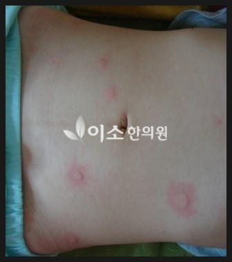 김ㅅㅇ_-_만성_두드러기_치료_전_복부