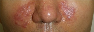 3_지루성피부염1