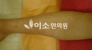 after_ㄱㅈㄱ_10대_청소년_자반_후,_우측_다리