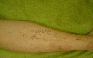 beforeㄱㅈㄱ_10대_청소년_자반_전,_우측_다리