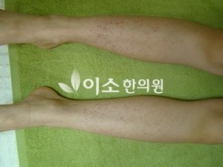 ㄱㅁㅅ_초등학생_자반_치료_전_(1)