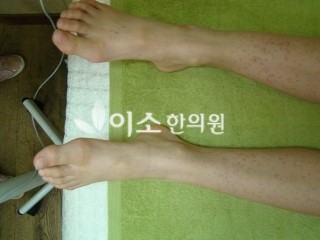 ㄱㅁㅅ_초등학생_자반_치료_전_(2)