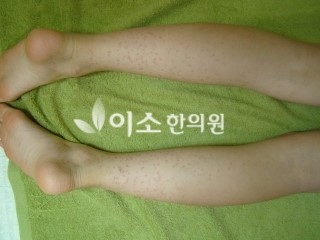 ㄱㅁㅅ_초등학생_자반_치료_전_(4)