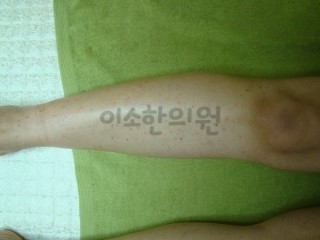 ㄱㅁㅅ_치료_전_(2)