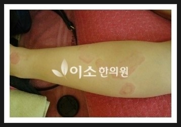 ㅇㅇㅎ_두드러기_전
