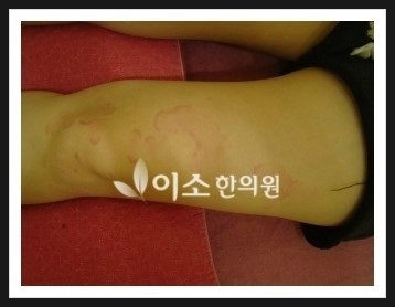 ㅇㅇㅎ_두드러기_전_좌측_허벅지