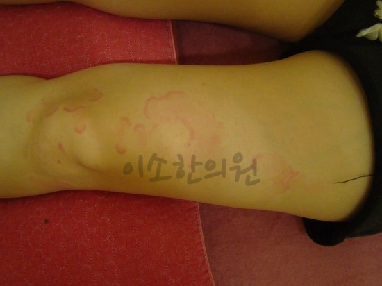 ㅇㅇㅎ_두드러기_전_좌측_허벅지