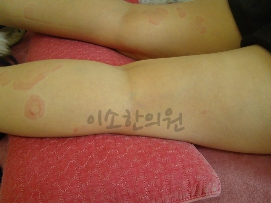 ㅇㅇㅎ_두드러기_전_허벅지