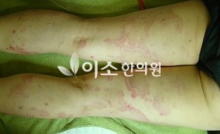 ㅇㅎㅅ_20년된_만성_두드러기_치료_전 (3)