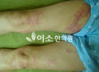 ㅇㅎㅅ_20년된_만성_두드러기_치료_전,_허벅지