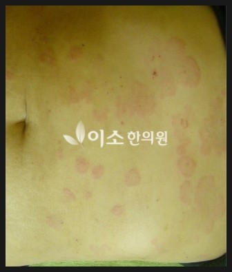 ㅇㅎㅅ_20된_만성_두드러기_치료_전_복부 (1)