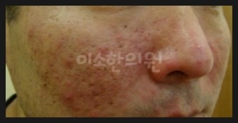 ㅈㅇㅊ_지루성_피부염_우측_전