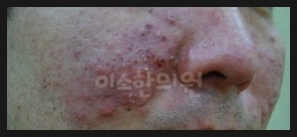 ㅈㅇㅊ_지루성_피부염_우측_후