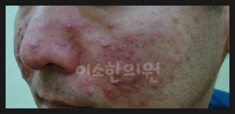 ㅈㅇㅊ_지루성_피부염_좌측_전 (1)