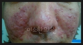 ㅈㅇㅊ_지루성피부염_전