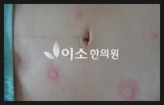 김ㅅㅇ_-_만성_두드러기_치료_전_복부 (1)