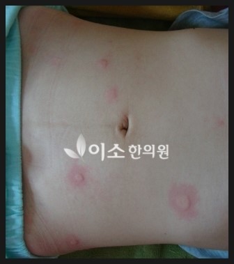 김ㅅㅇ_-_만성_두드러기_치료_전_복부 (2)