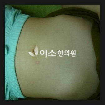 김ㅅㅇ_-_만성_두드러기_치료_후_복부