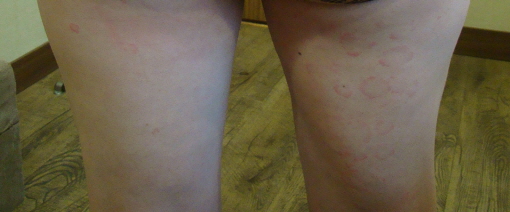 다리_두드러기_후