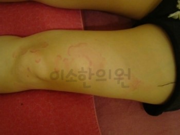 두드러기_치료전_(1) (1)