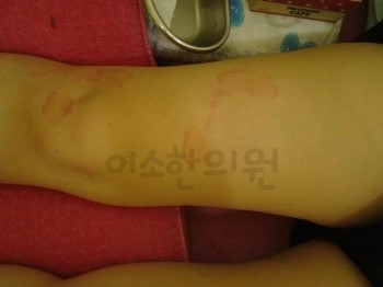 두드러기_치료전_(2)