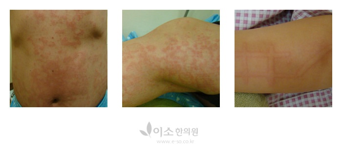 두드러기증상