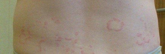 등,_두드러기_전