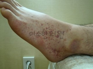 발쪽_자반증_(2)