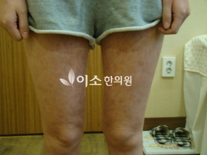 장미색_비강진_증상_다리_-_복사본