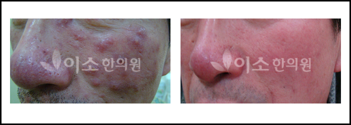 지루성피부염치료사례_02