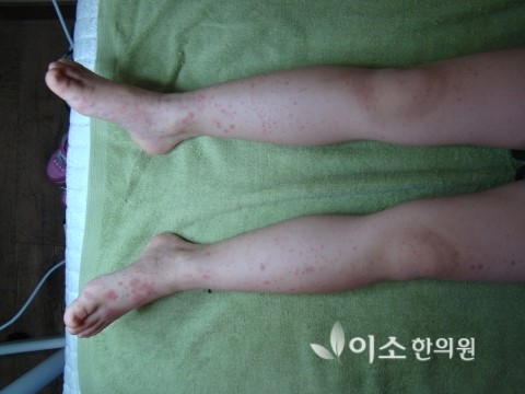 최예은_치료_전