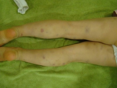 피멍든듯한_자반