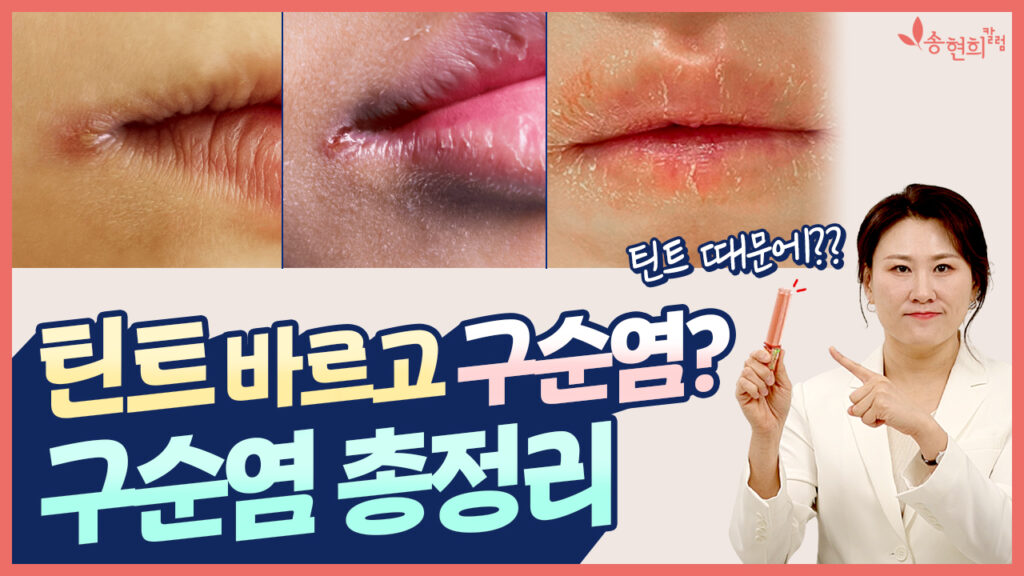 구순염 총정리