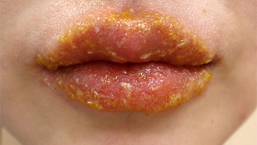 구순염 증상