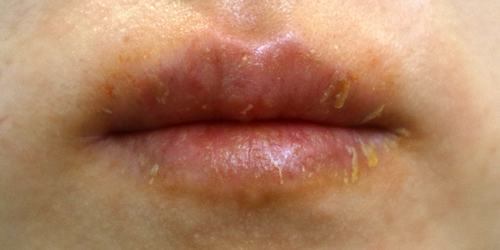 접촉성 구순염 증상