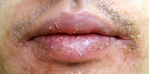 구각 구순염 증상