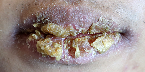 박탈성 구순염 증상