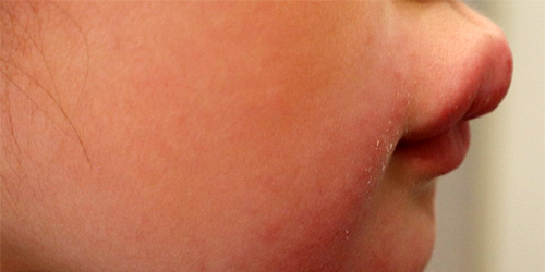 육아종성 구순염 증상