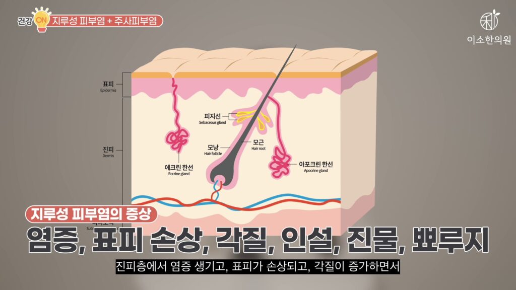 지루성 피부염의 증상, 염증, 표피 손상, 각질, 인설, 진물, 뾰루지