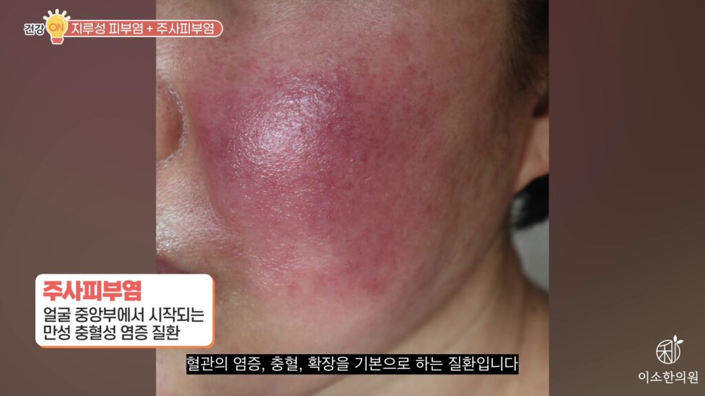 주사피부염은 얼굴 중앙부에서 시작되는 만성 충혈설 염증 질환