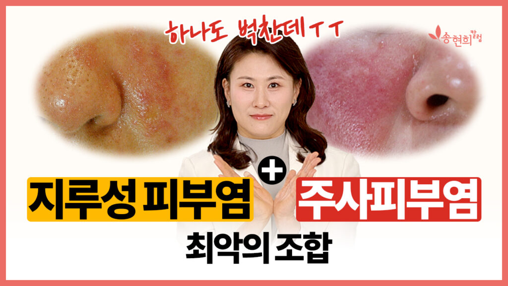 지루성 피부염+주사피부염 최악의 조합