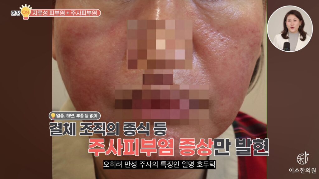 결체 조직 증식은 주사피부염 증상