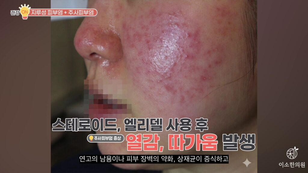 스테로이드, 엘리델 사용 후 열감, 따가움 발생은 주사피부염 증상
