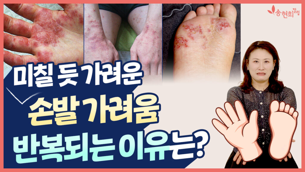 미칠 듯 가려운 손발 가려움, 반복되는 이유는?